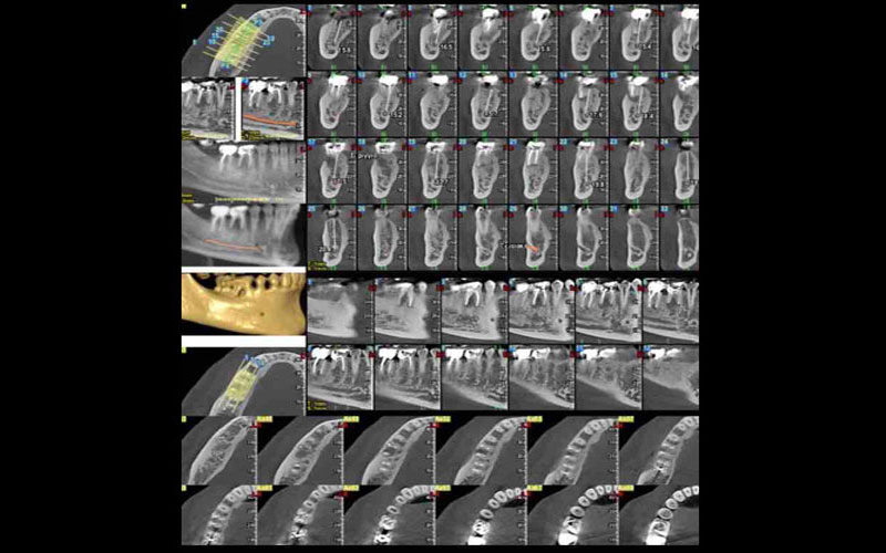 ΝΕΕΣ ΤΕΧΝΙΚΕΣ - COMPUTER GUIDED SYRGERY (DSD, PRP)